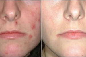 dermaseptic cream до и после применения
