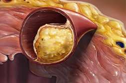 Благодаря Cardiocidin наслоения на сосудах устраняются за один курс лечения.