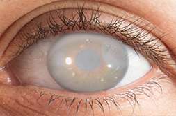 Perfect Vision предотвращает развитие серьёзных офтальмологических заболеваний.